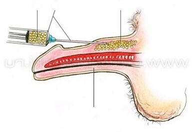Pagpadako sa Penisasyon sa Injection