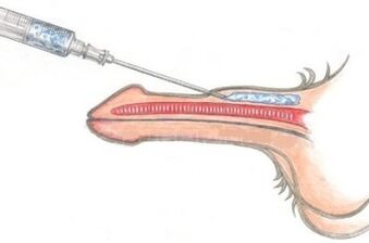 Usa ka makuyaw nga paagi sa pagpadako sa kinatawo gamit ang Vaseline injection